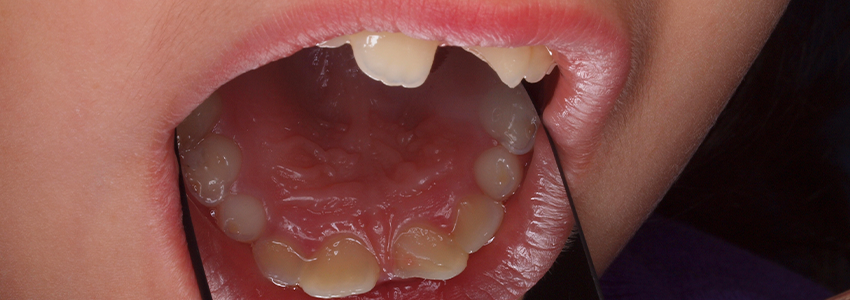 Diploma de Especialización en Traumatología Dental